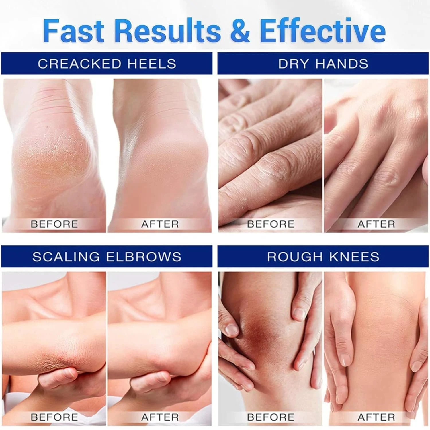 Крем для ног Urea 40% с гиалуроновой кислотой интенсивное увлажнение 150 г, фото №5