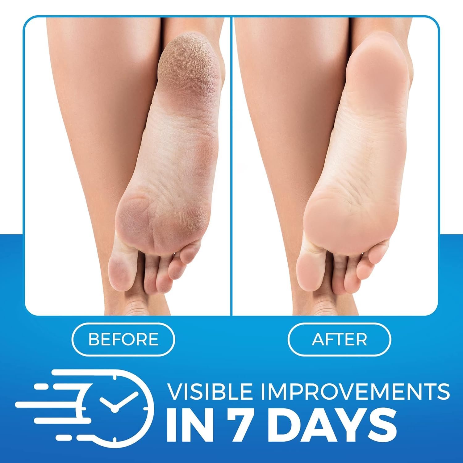 Бальзам для ніг Imperial Feet Urea зволожувальний відлущувальний із сечовиною та антиоксидантами 150 мл, фото №2