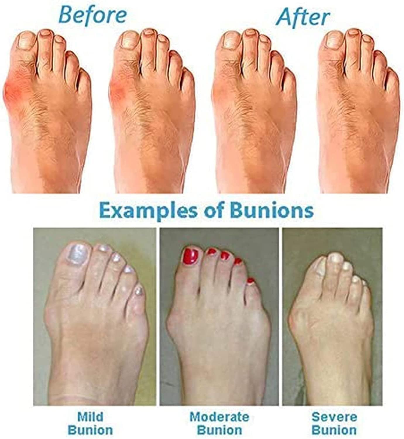 Шлепанцы Корректор Большого Пальца Стопы Hallux Valgus, фото №2