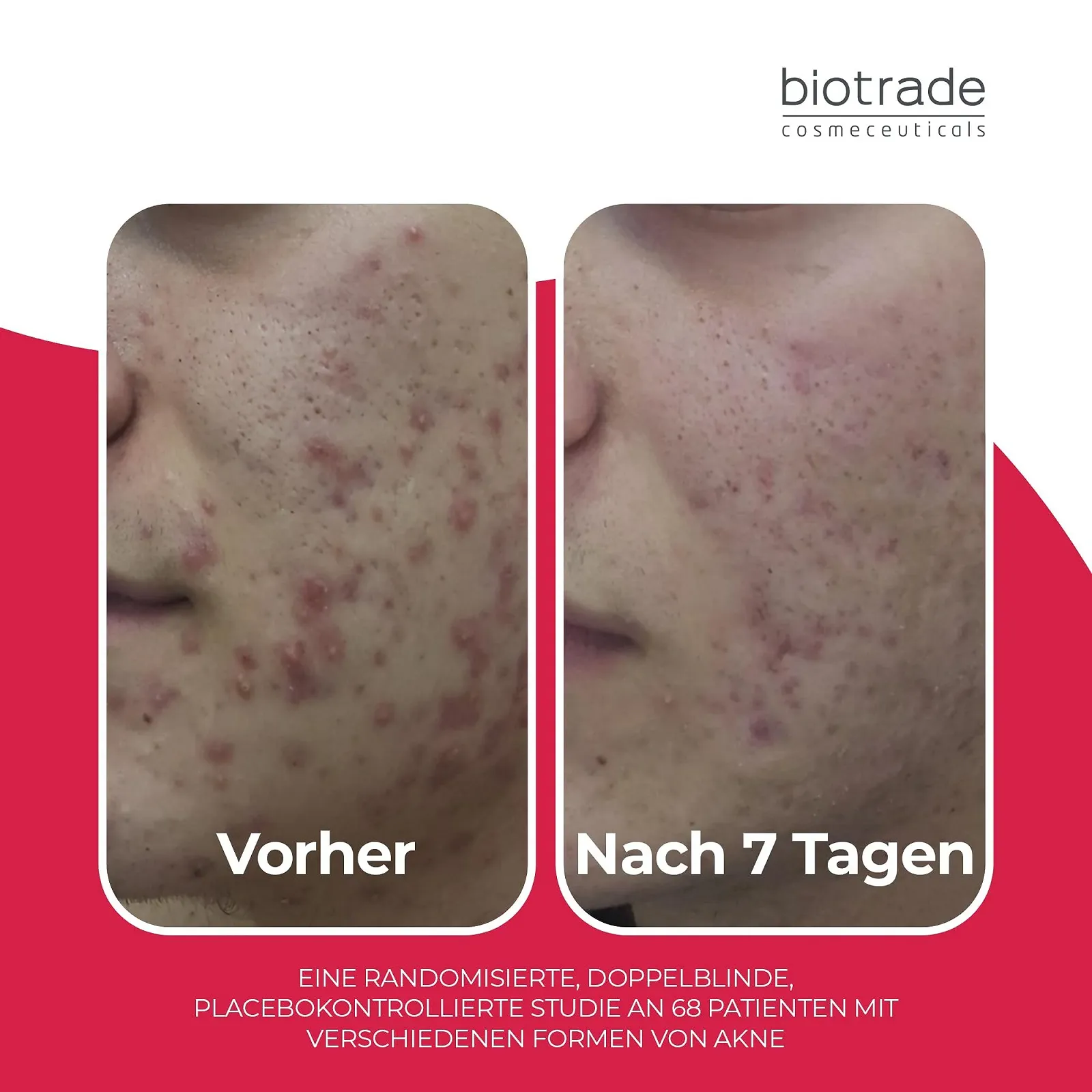 Активний крем Biotrade Acne Out для жирної та схильної до акне шкіри 30 мл, фото №7 Активний крем Biotrade Acne Out для жирної та схильної до акне шкіри 30 мл, фото №7