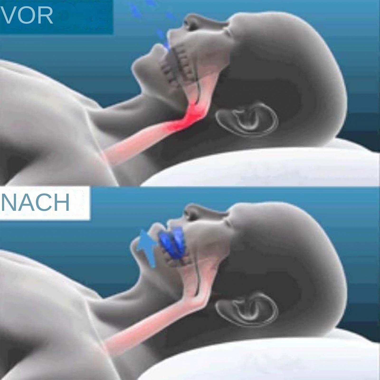 Пристрій проти хропіння, 2 шт., фото №5