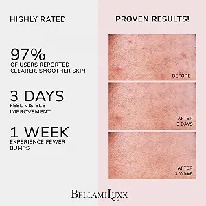 Крем от прыщей BellamiLuxx для ягодиц и тела: крем от акне против фолликулита и прыщей на спине, ягодицах и бедрах, с 2% салициловой кислотой и маслом чайного дерева synthetic.ua - Фото 1