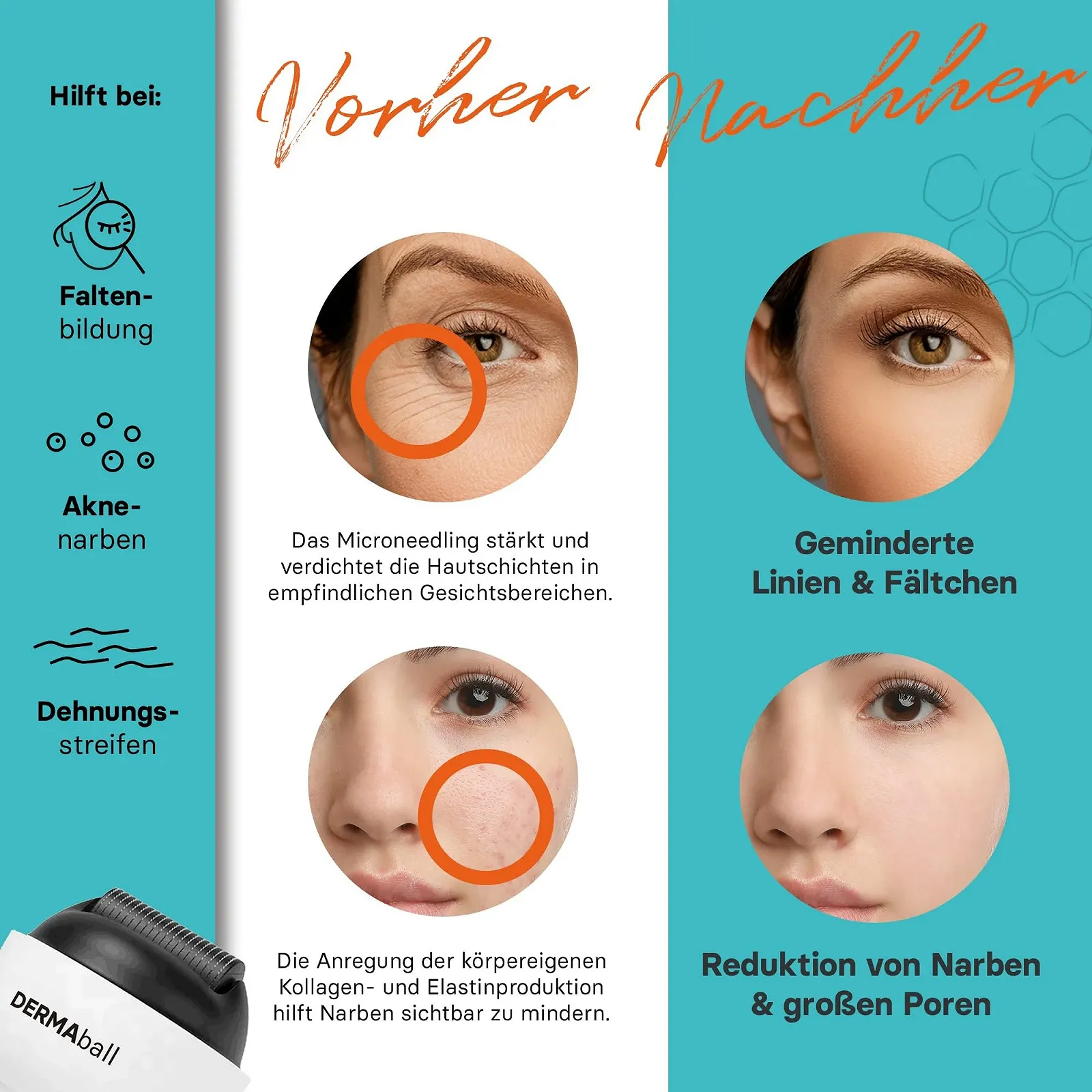 Дермаролер BS Luxry Premium, 1200 мікроголок з нержавіючої сталі, 0,5 мм, фото №8