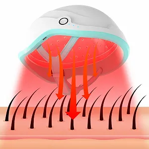 Шлем лазерний LLLT для росту волосся при випадінні волосся - Фото 1