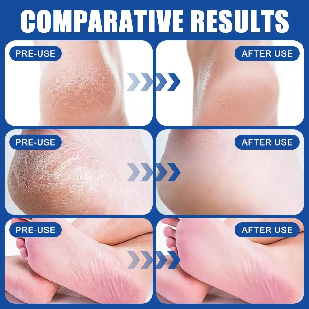 Крем для ног Urea Foot Cream увлажняющий против трещин 60% 3 шт., фото №4