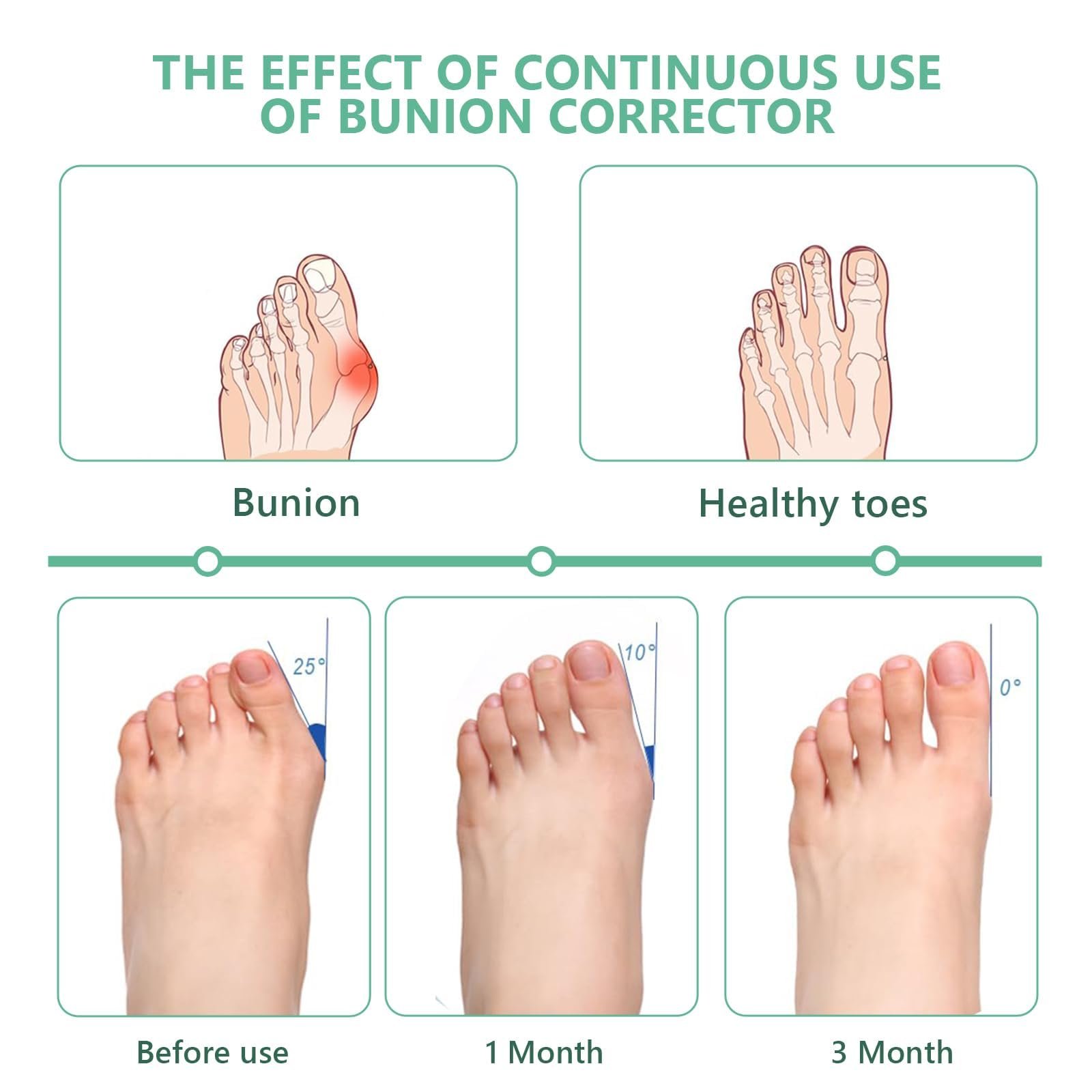 Шина для корекції Hallux Valgus, пов'язка Hallux Valgus для чоловіків і жінок, фото №3