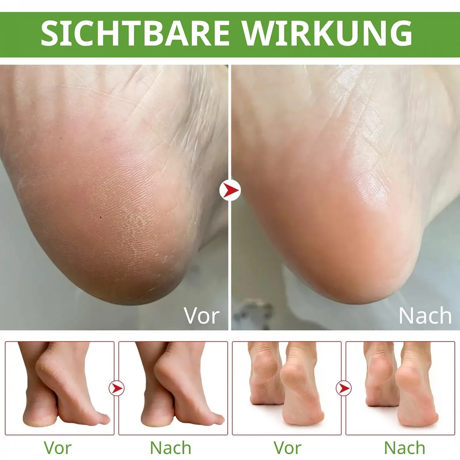 Крем для ног Urea Cream 40% против мозолей алоэ вера масло чайного дерева, фото №7 Крем для ног Urea Cream 40% против мозолей алоэ вера масло чайного дерева, фото №7