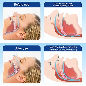 Антихрап пристрій 8 шт Багаторазовий розширювач synthetic.ua - Фото 1