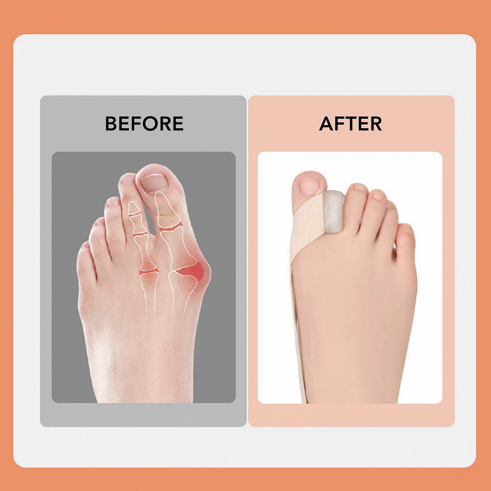 Корректор вальгусной деформации большого пальца стопы Ремень Щелевой Благоприятный для кожи Улучшает боль Hallux Valgus Удобный Боковой перекрестный Эластичный Bunion (S), фото №2