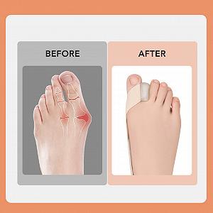 Корректор вальгусной деформации большого пальца стопы Ремень Щелевой Благоприятный для кожи Улучшает боль Hallux Valgus Удобный Боковой перекрестный Эластичный Bunion (S) synthetic.ua - Фото 1