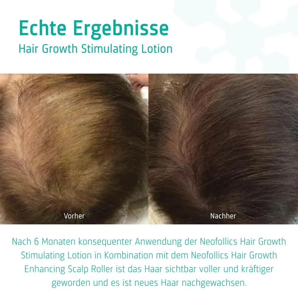 Лосьйон Neofollics Стимулюючий ріст волосся - Стимулюючий ріст волосся, фото №5