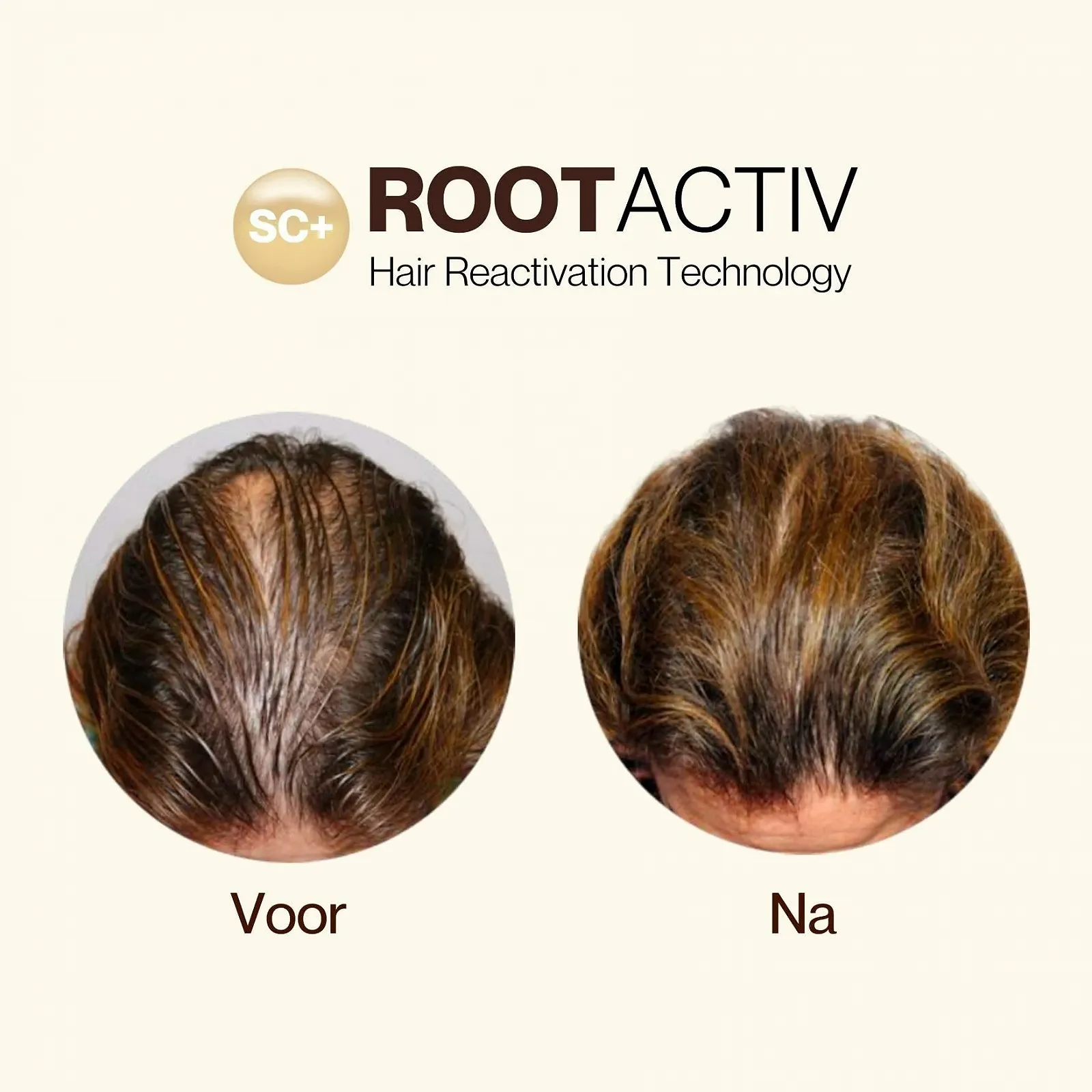 Сироватка для росту волосся зі стовбуровими клітинами SC+ ROOTACTIV для жінок та чоловіків, 75 мл, фото №5
