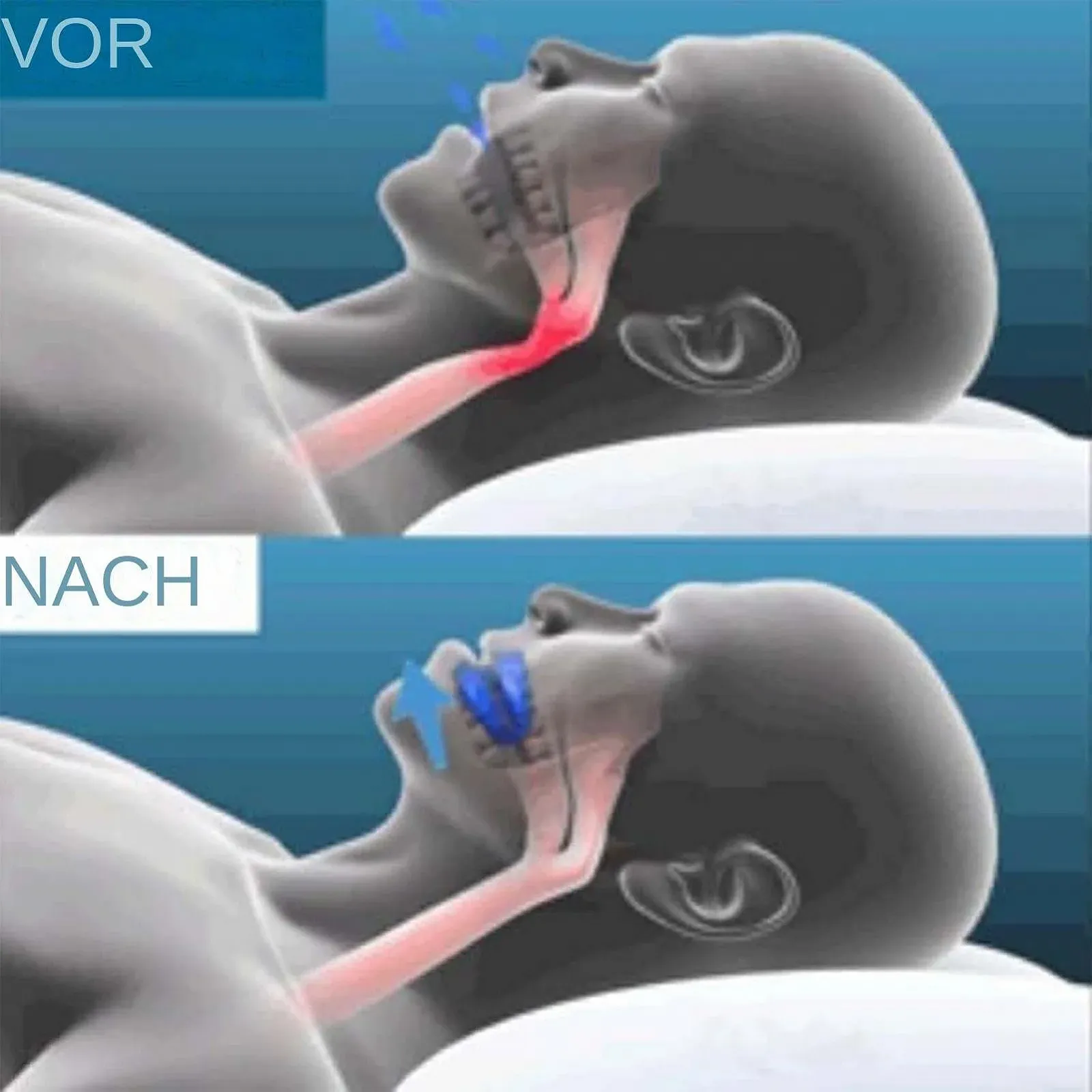 Захист від хропіння, Anti-Schnarch, ротовий захист, фото №4 Захист від хропіння, Anti-Schnarch, ротовий захист, фото №4