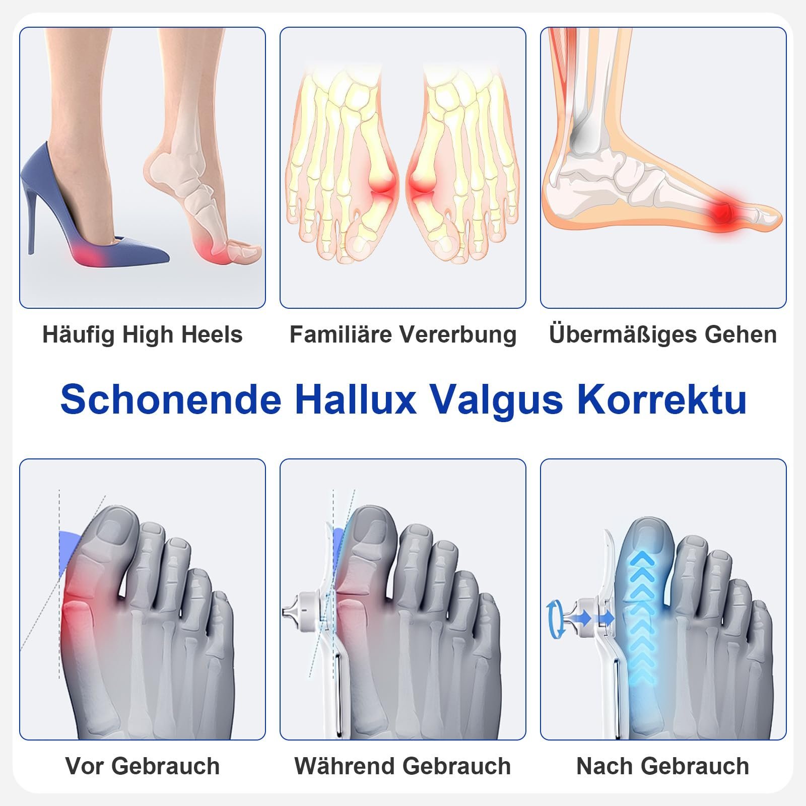 Шина для корекції Hallux Valgus, набір для корекції вальгусної деформації великого пальця стопи, фото №3 Шина для корекції Hallux Valgus, набір для корекції вальгусної деформації великого пальця стопи, фото №3