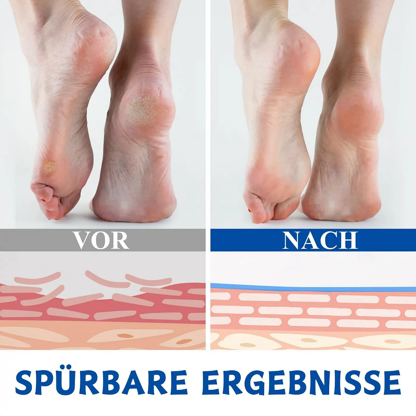 Крем для ног с мочевиной 60% против мозолей и трещин 100 г, фото №4