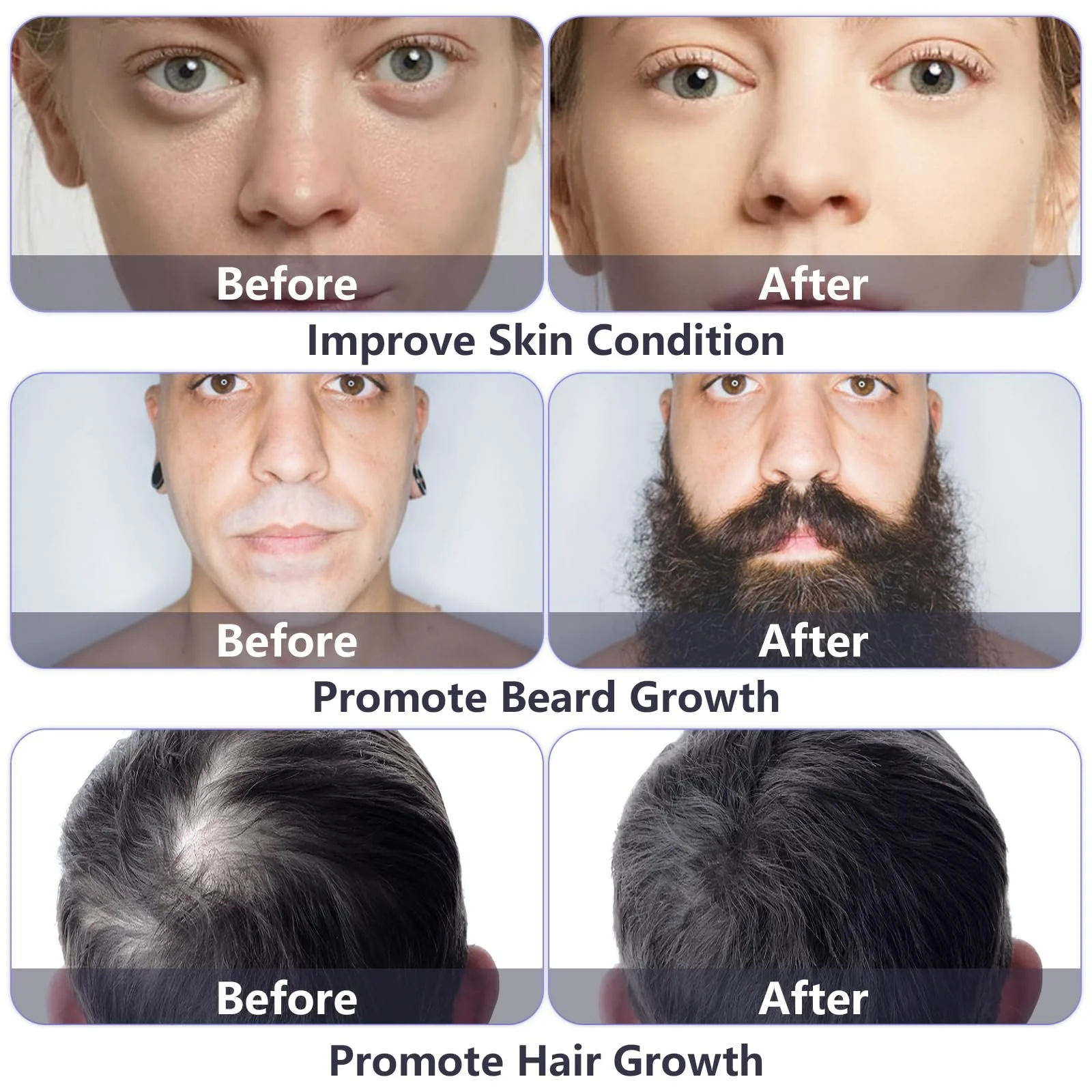 Ролик для бороди GeeRic 0.3 мм, мікроголковий ролик для обличчя та тіла, фото №6