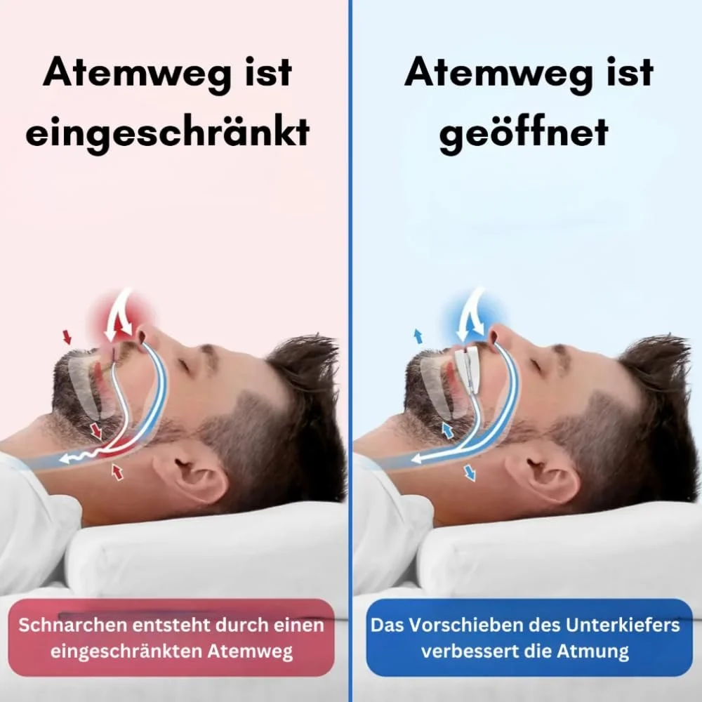 Ротовий Апарат Проти Хропіння Pomera Snoring Free Nuraya Ефективний Засіб для Спокійного Сну, фото №2