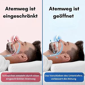 Ротовой Аппарат Против Храп Pomera Snoring Free Nuraya Эффективное Средство для Спокойного Сна synthetic.ua - Фото 1