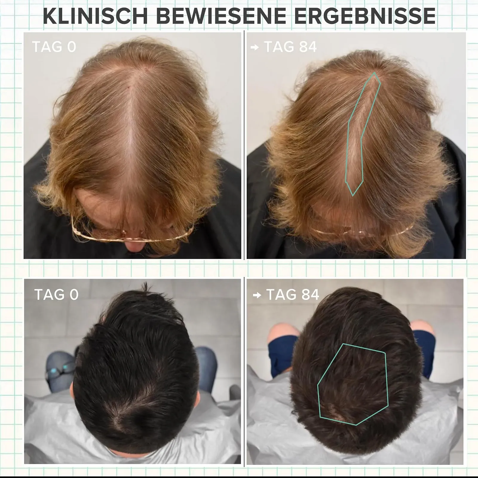 Сироватка проти випадіння волосся ULTI Paris Біотин + Розмарин + Capilia Longa Для чоловіків і жінок, фото №6 Сироватка проти випадіння волосся ULTI Paris Біотин + Розмарин + Capilia Longa Для чоловіків і жінок, фото №6