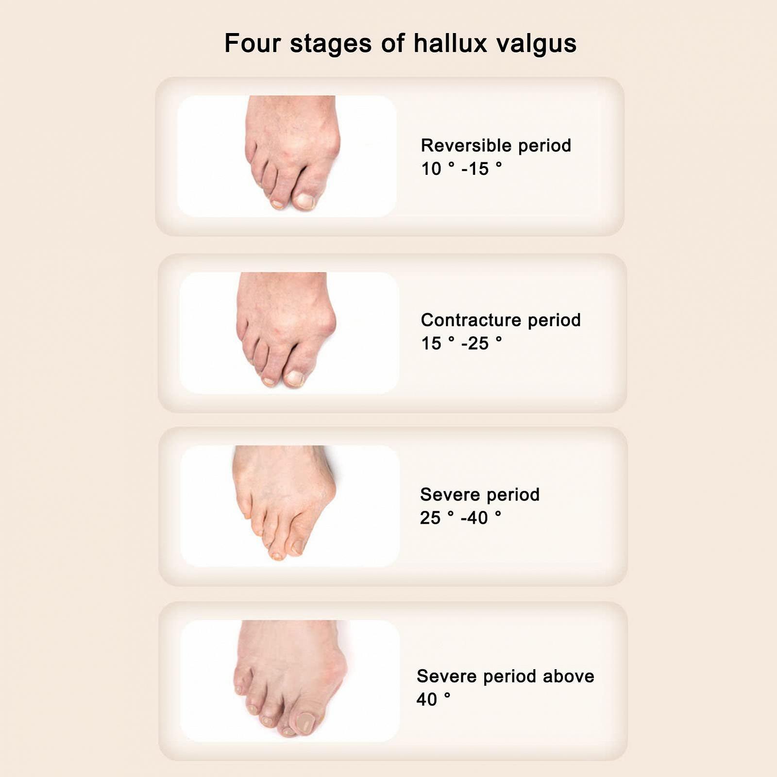 Шина для великого пальця стопи Регульована професійна м'яка ортопедична для денного та нічного відновлення, фото №4