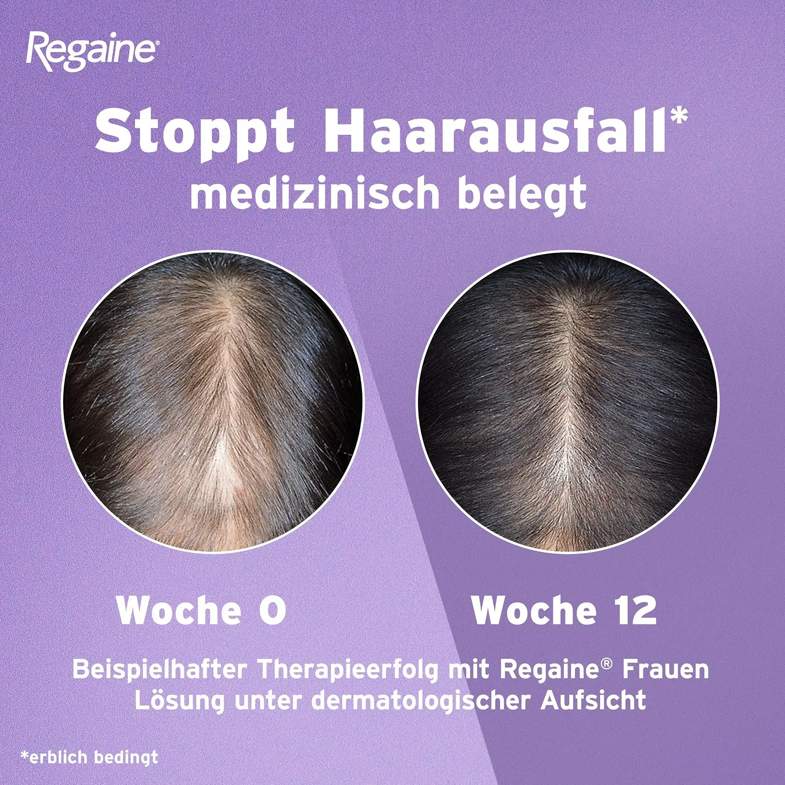 Розчин REGAINE Жіночий, з 2% Міноксидилом, 1 місяць, фото №5 Розчин REGAINE Жіночий, з 2% Міноксидилом, 1 місяць, фото №5