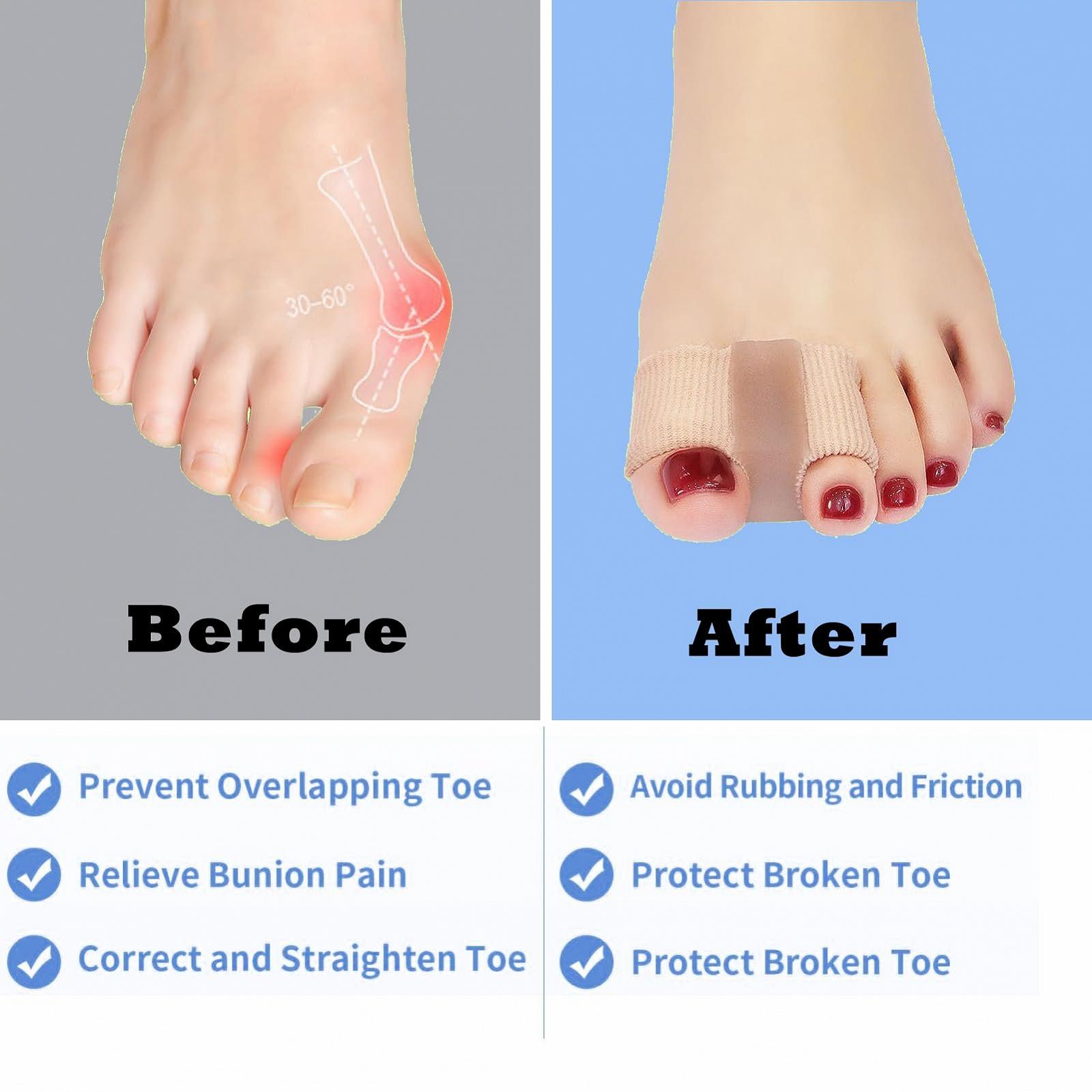 Разделитель для пальцев ног Bunion Corrector Большой выпрямитель для пальцев ног с 2 петлями Bunion Protector Подходит для коррекции Hallux Valgus для женщин и мужчин, фото №3 Разделитель для пальцев ног Bunion Corrector Большой выпрямитель для пальцев ног с 2 петлями Bunion Protector Подходит для коррекции Hallux Valgus для женщин и мужчин, фото №3