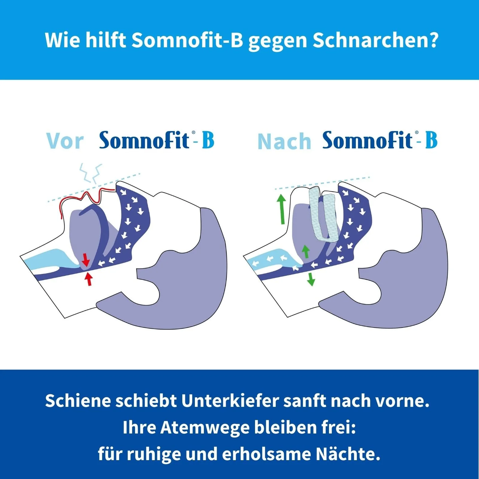 Капа от храпа B Для большой челюсти Somnofit-B, фото №4 Капа от храпа B Для большой челюсти Somnofit-B, фото №4