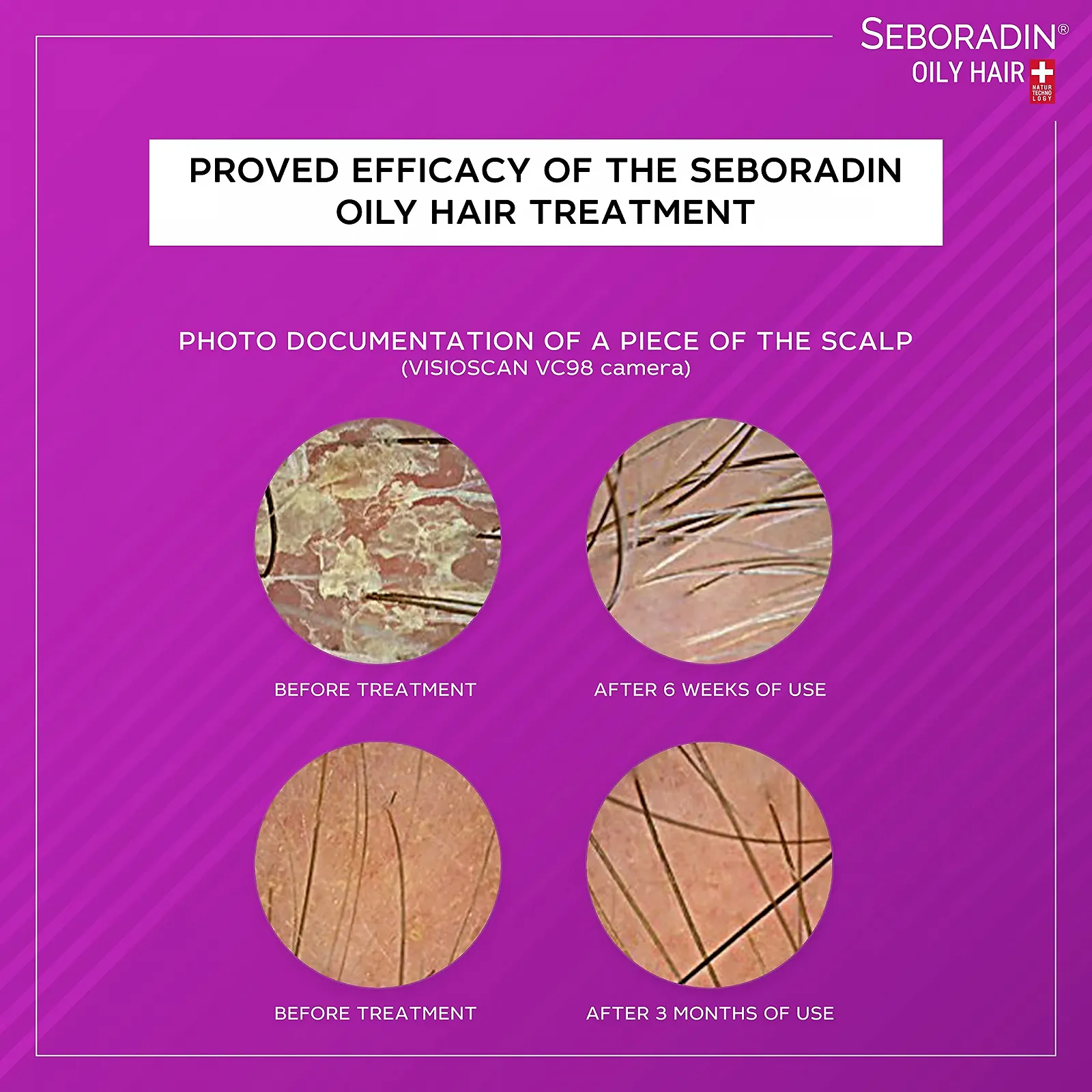 Ампули Seboradin для жирного волосся проти випадіння волосся при псоріазі та лупі, фото №7