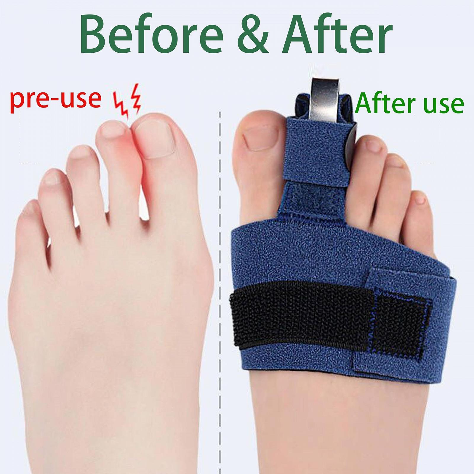 Коректор для молоткоподібних пальців, набір, фото №2