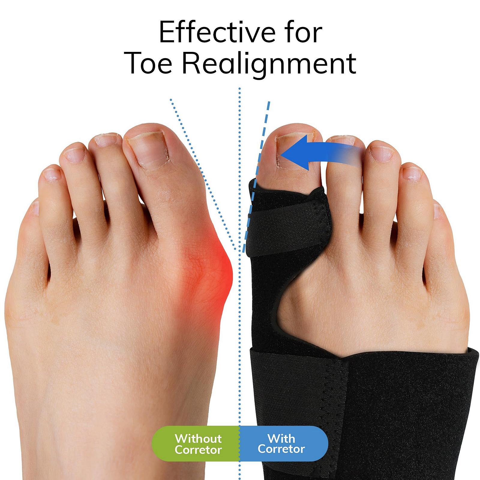 Коректор вальгусної деформації Fittest Pro (2 шт.) Великий роздільник пальців, фото №3