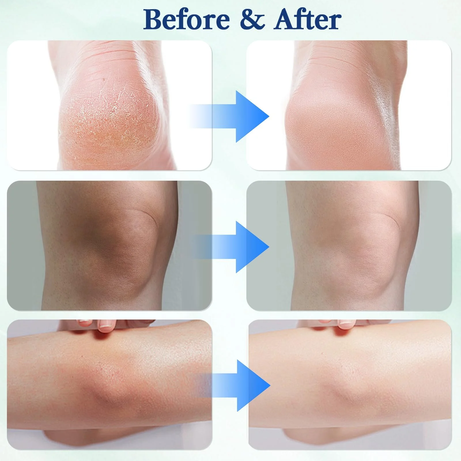 Крем для ног Urea Cream 60% восстанавливающий от мозолей увлажняющий 100 г, фото №5