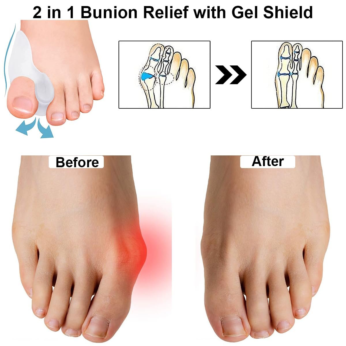 Роздільники для пальців ніг для корекції Hallux Valgus, фото №4 Роздільники для пальців ніг для корекції Hallux Valgus, фото №4