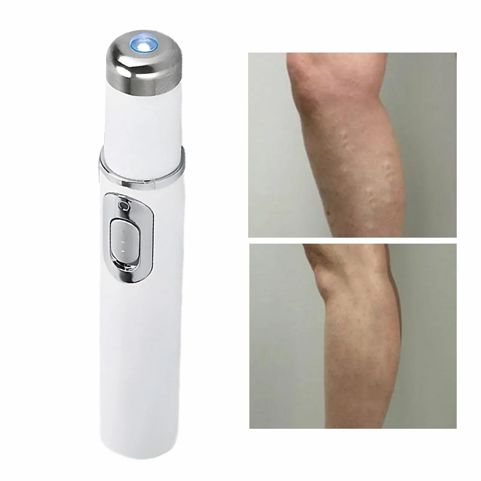 Прибор для удаления сосудистых сеточек Wireless Vein Care Pen беспроводной, фото №7