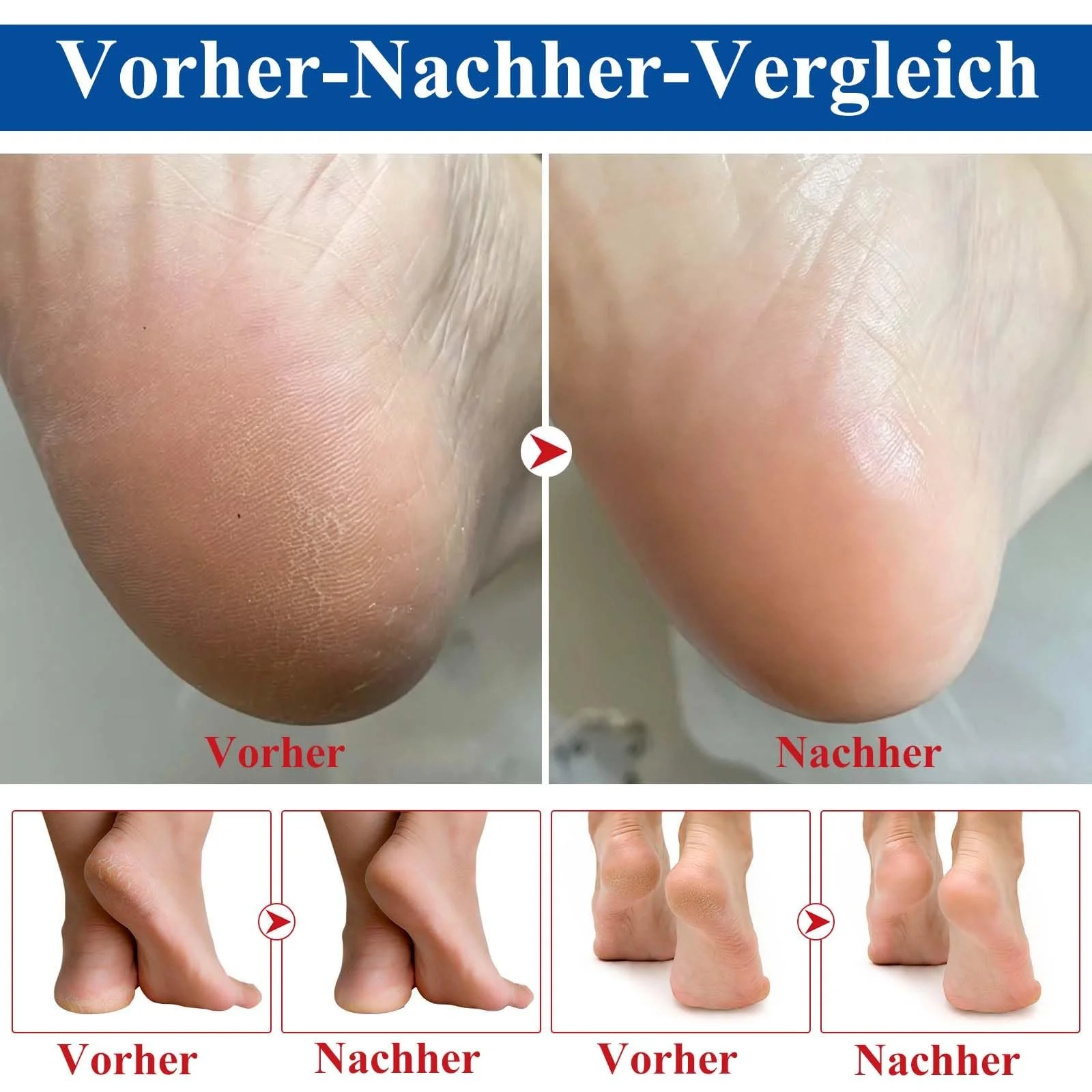 Крем для ног Urea 60% для очень сухой кожи и потрескавшихся пяток увлажняющий стик, фото №6 Крем для ног Urea 60% для очень сухой кожи и потрескавшихся пяток увлажняющий стик, фото №6