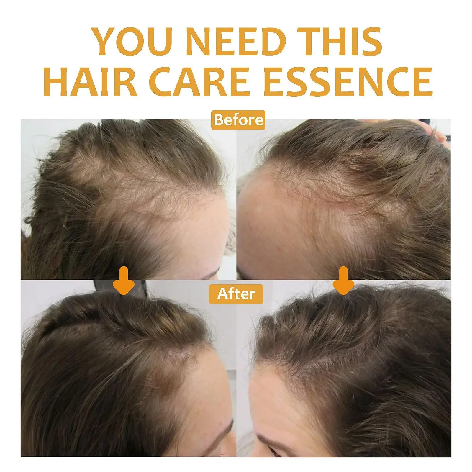 Сироватка для росту волосся Біотин, Набір Спрей для росту волосся Біотин, з дерма-ролером, фото №5