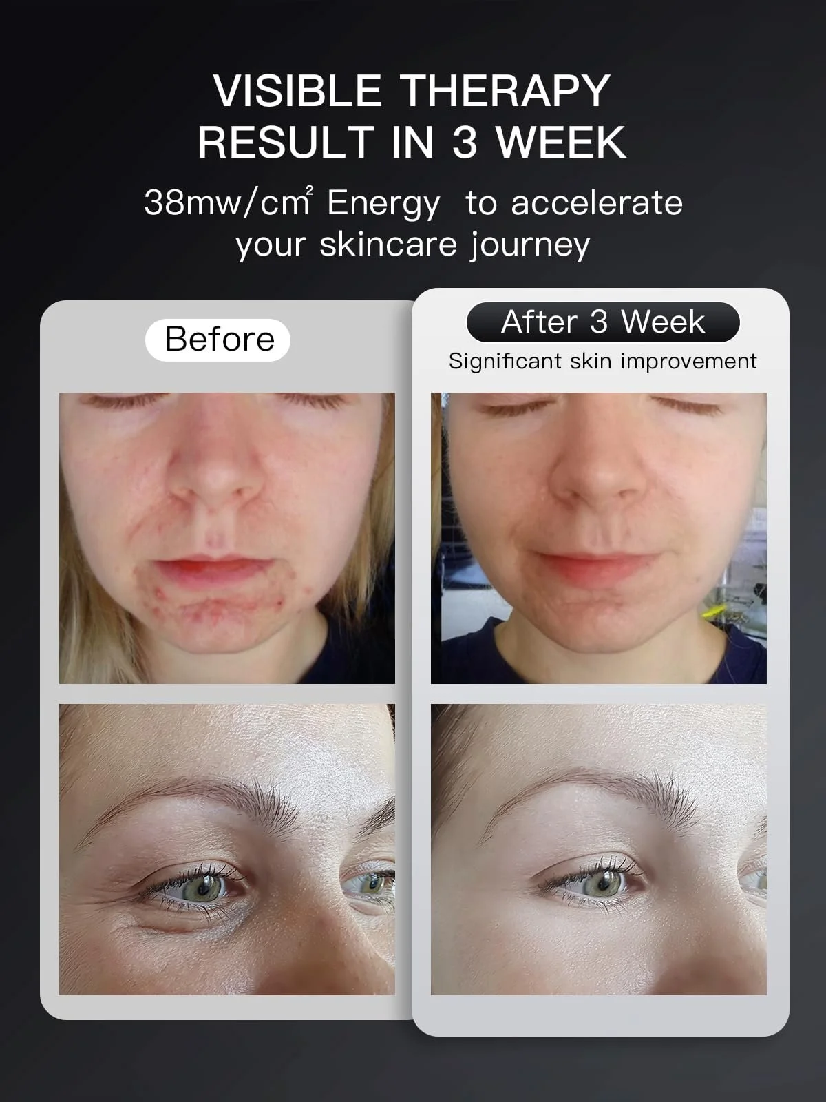 LED Маска для лица IBORRIA с красным светом, LED светотерапия для лица и кожи, 3 цвета с ближним инфракрасным светом, фото №7 LED Маска для лица IBORRIA с красным светом, LED светотерапия для лица и кожи, 3 цвета с ближним инфракрасным светом, фото №7