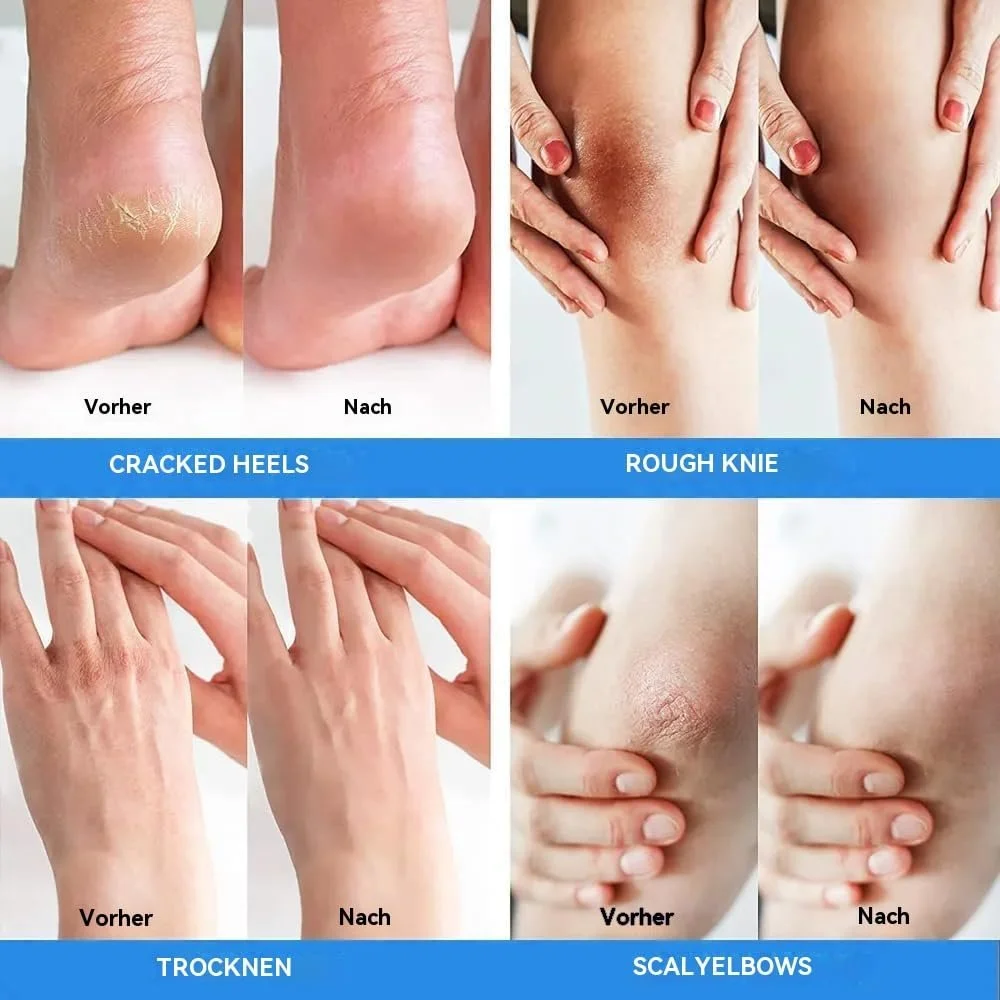 Крем для ног с 42% мочевиной и 2% салициловой кислотой 150 г (5.29 oz) Для сухих пяток и мозолей, фото №7