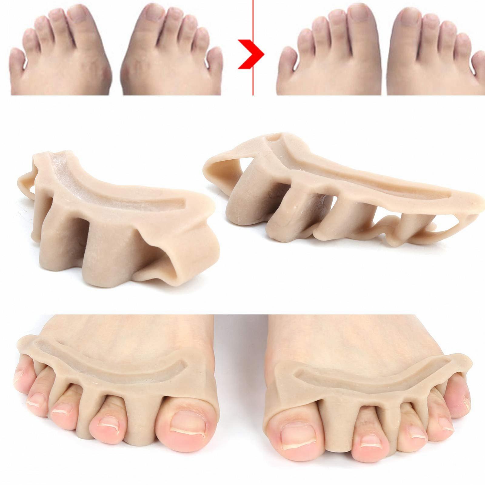 Коректор Hallux Valgus, 2 шт, вальгусної деформації великого пальця стопи, Унісекс, фото №6 Коректор Hallux Valgus, 2 шт, вальгусної деформації великого пальця стопи, Унісекс, фото №6