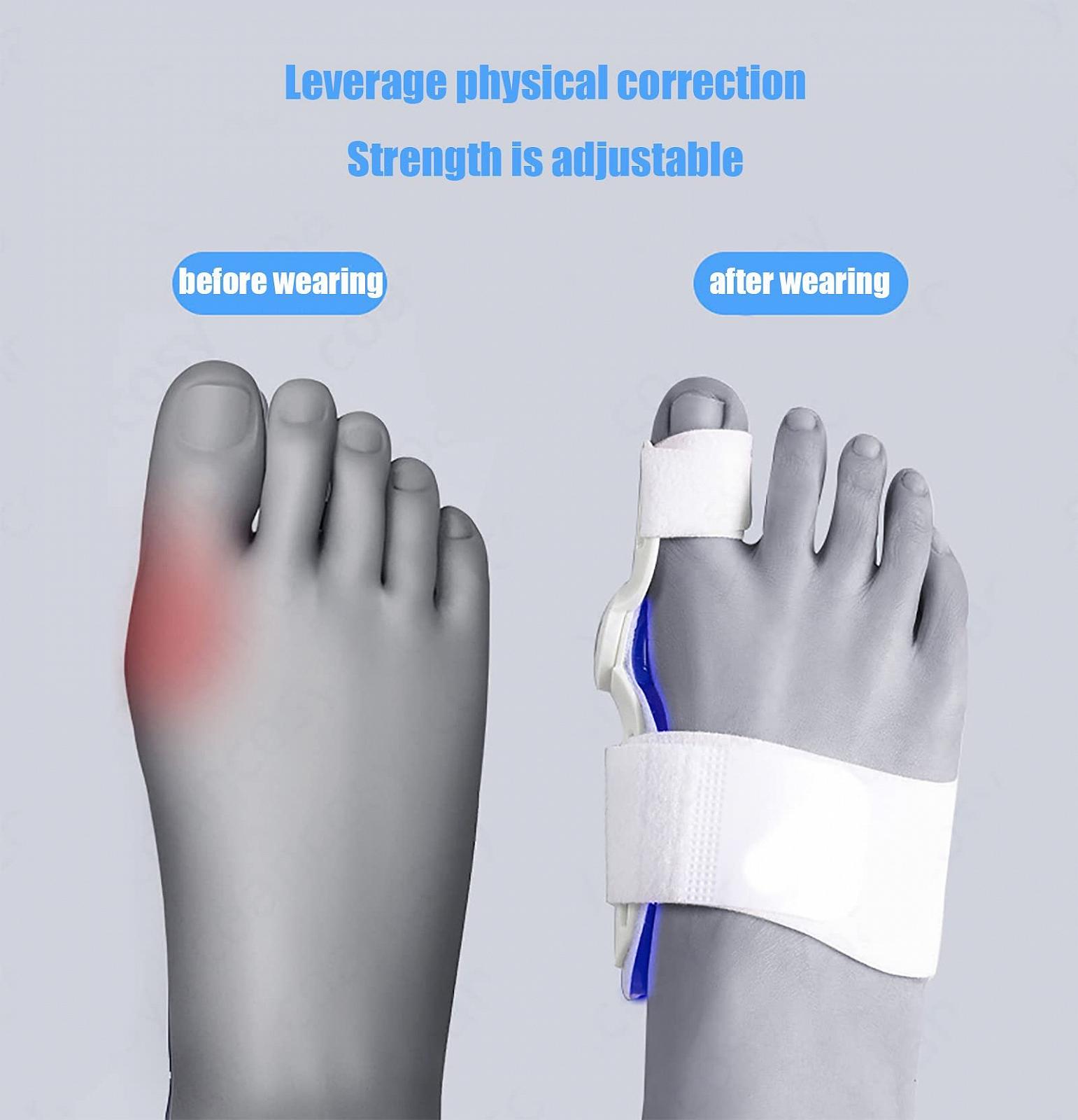 Коректор вальгусної деформації для жінок та чоловіків, фото №4 Коректор вальгусної деформації для жінок та чоловіків, фото №4
