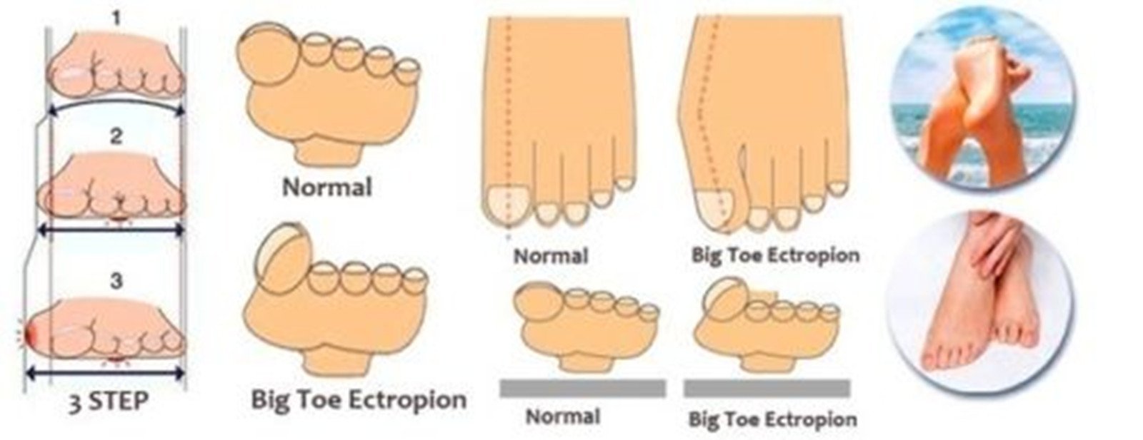 Коректор великого пальця стопи Гелевий 1 пара Білий, фото №3