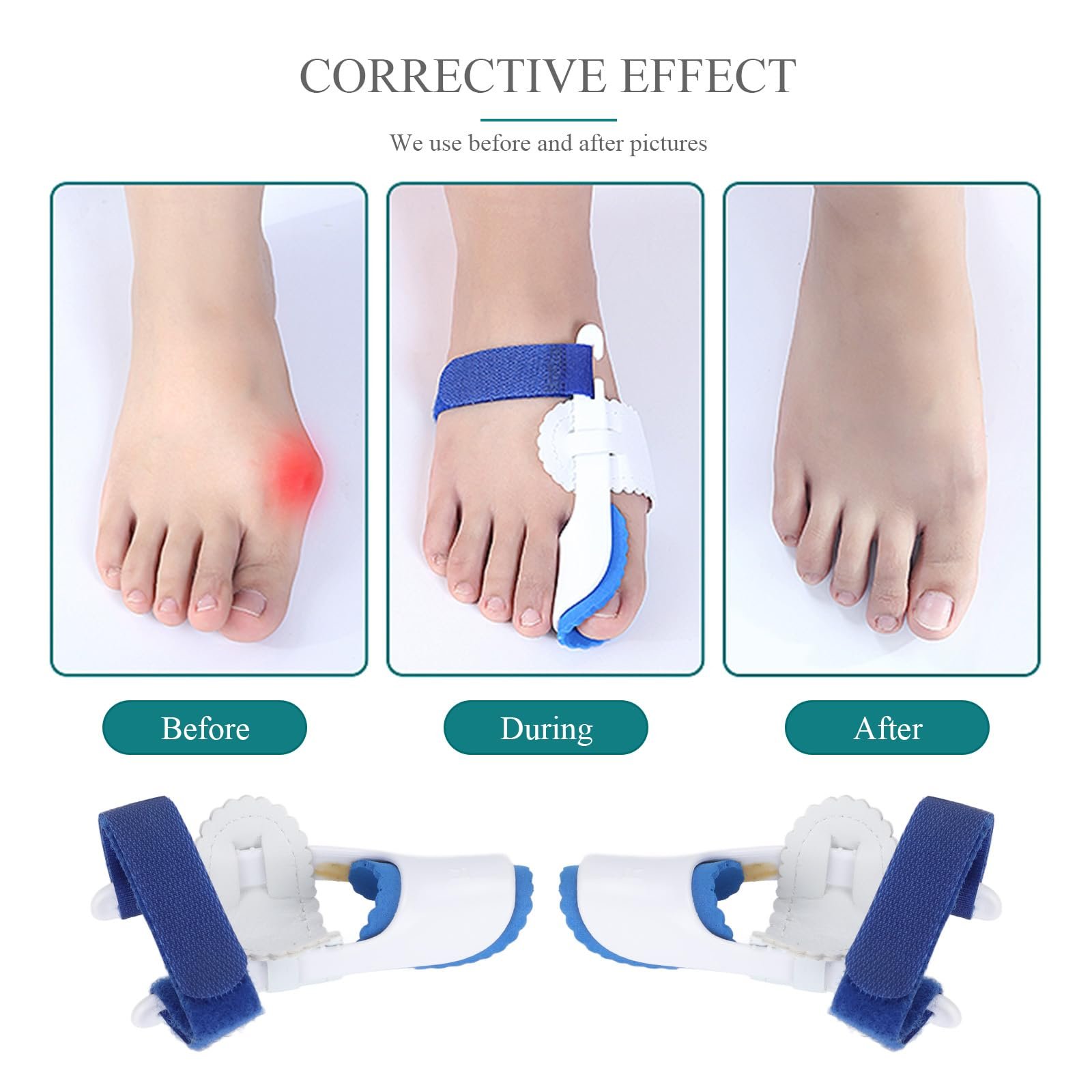 Коректор Hallux Valgus для пальців ніг, бандаж для полегшення болю при вальгусній деформації, фото №4