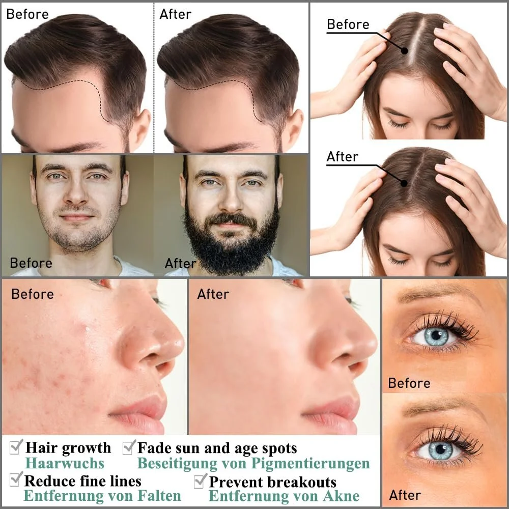 Набір дермаролерів Zemolo, 2 шт., 0,5 мм з 1,0 мм, ролер для бороди з мікроголками 540, фото №4