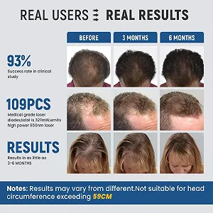 Шолом Лазерний iKeener lllt для росту волосся 109 лазерних діодів 650 нм synthetic.ua - Фото 1