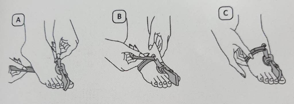 Нічна шина Hallux Valgus Russka для корекції зміщення великого пальця стопи, фото №1 Нічна шина Hallux Valgus Russka для корекції зміщення великого пальця стопи, фото №1