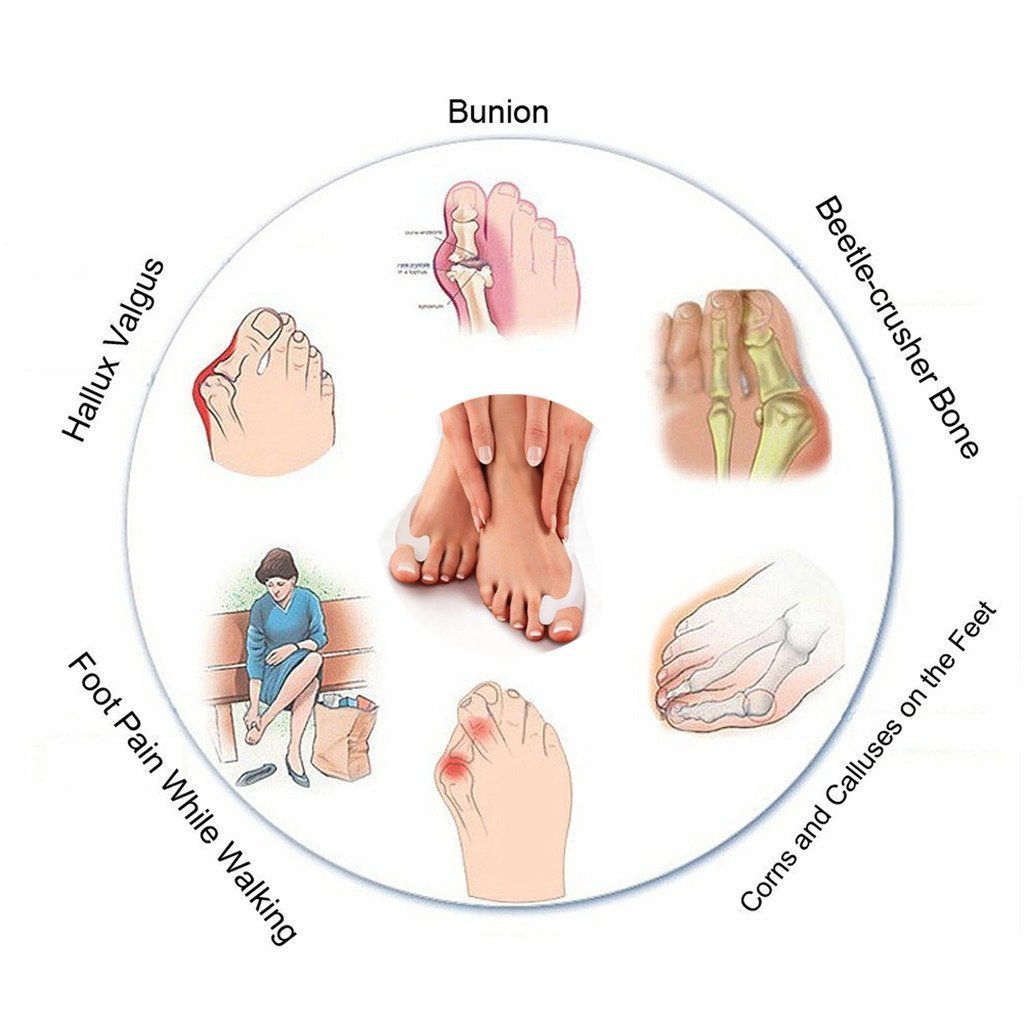 Роздільник для пальців Hallux Valgus PEDIMEND x8, фото №3 Роздільник для пальців Hallux Valgus PEDIMEND x8, фото №3