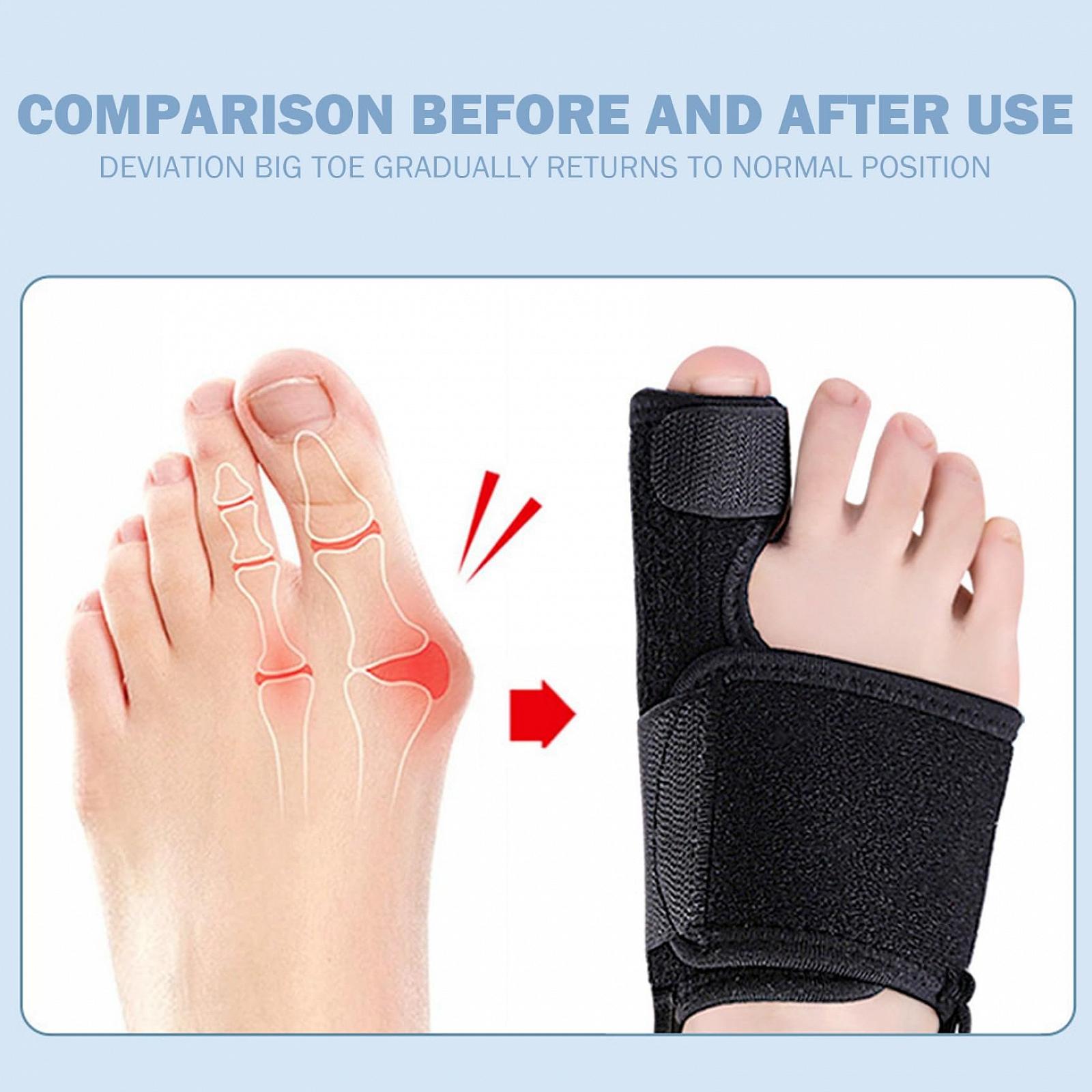 Коректор для великого пальця стопи (вальгусної деформації), 1 пара, регульований, дихаючий ортез з алюмінієвими стрижнями, фото №5