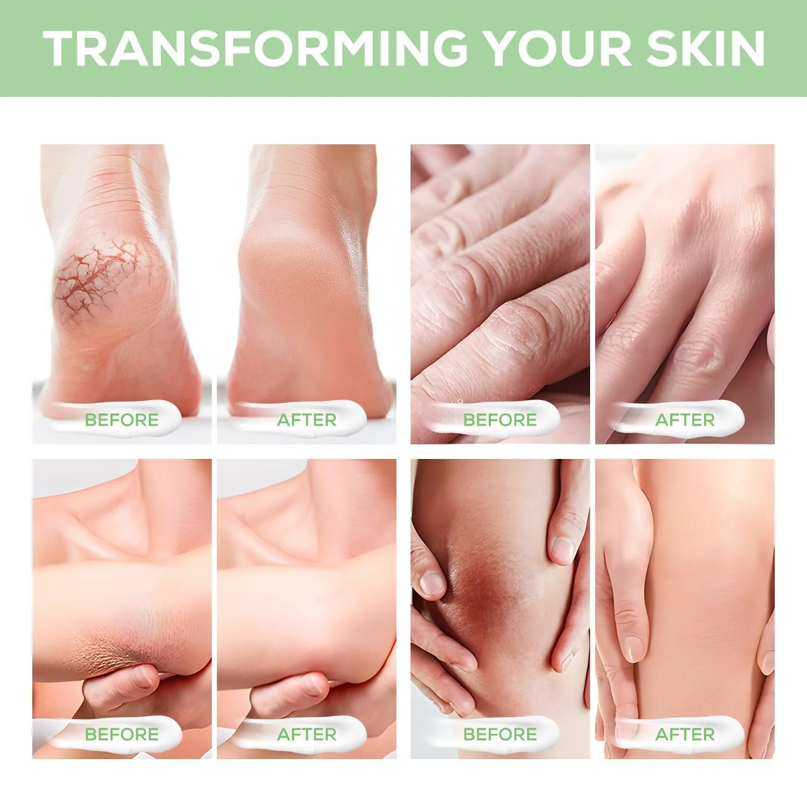 Крем для ніг Urea Cream 40% з гіалуроновою кислотою, чайним деревом та алое вера 120 г, фото №4