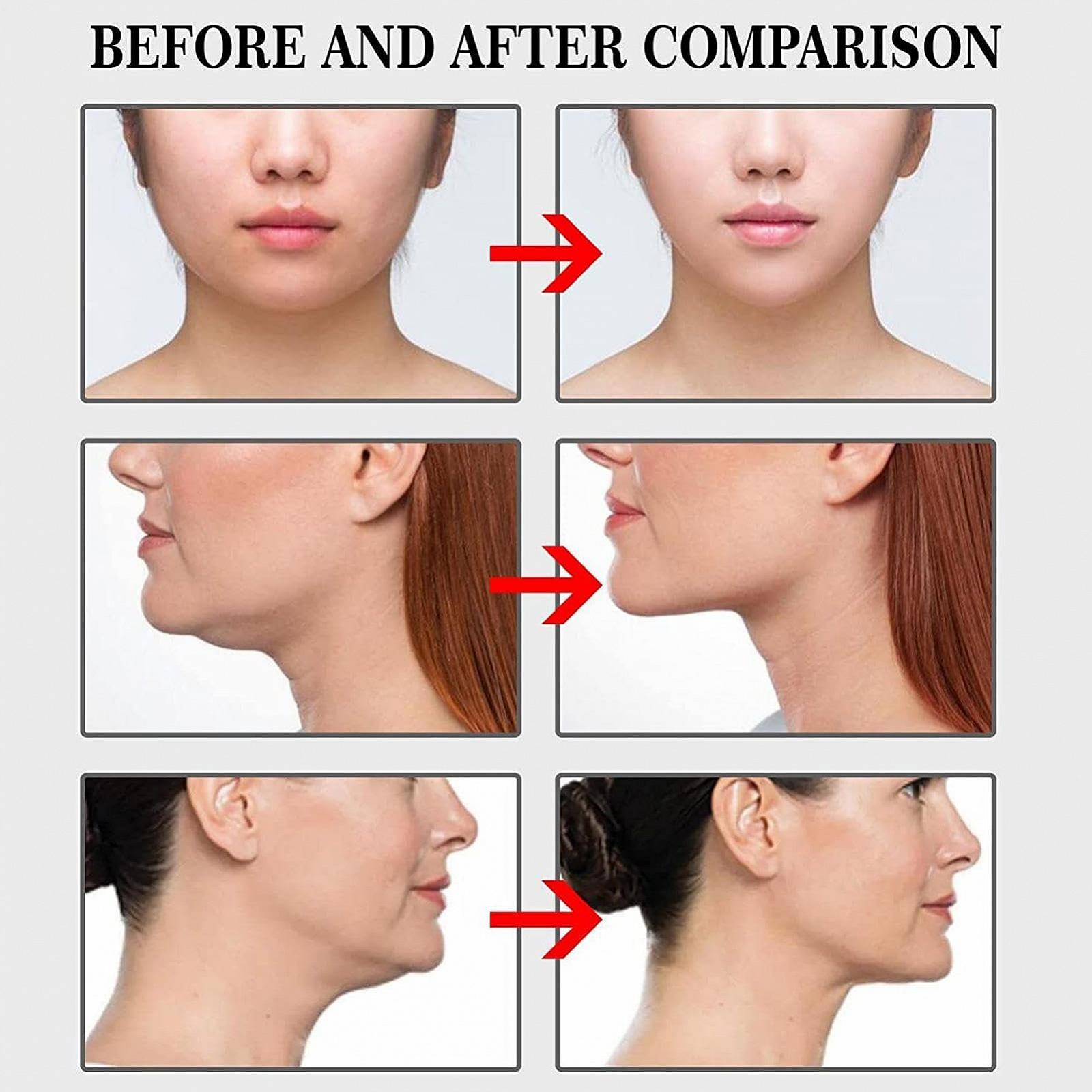 Лента для лица Faceling Invisible V Shape, прозрачная, для подтяжки подбородка и щек, фото №8