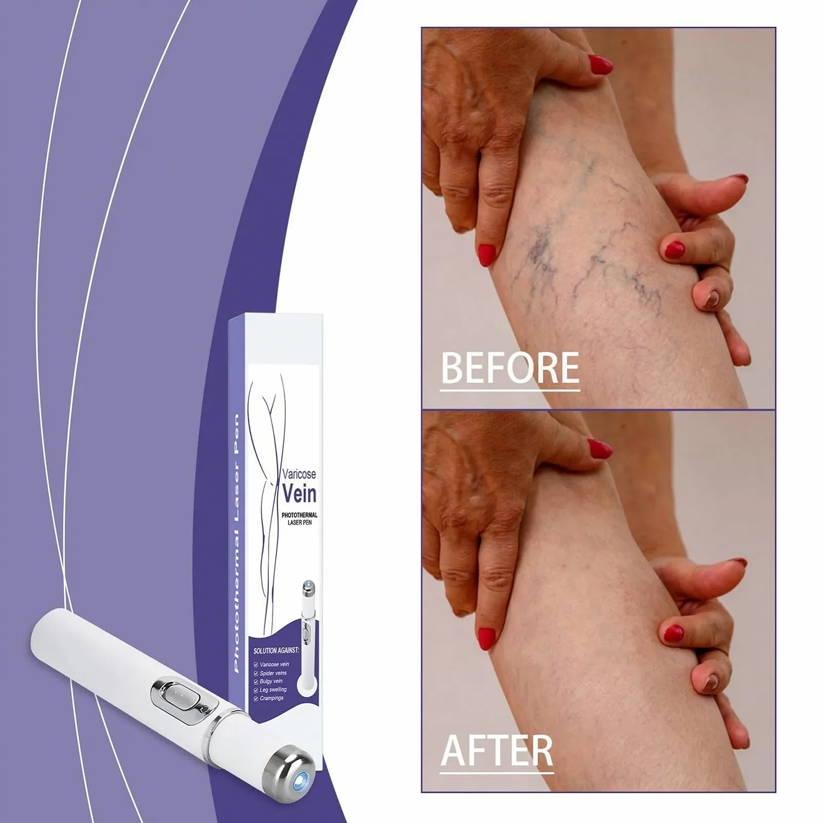 Карандаш для удаления сосудистых звездочек Portable Vein Pen для ног, фото №2