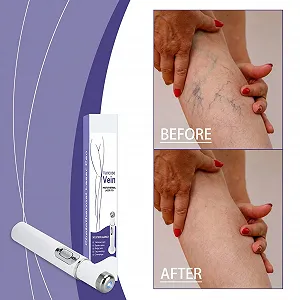 Карандаш для удаления сосудистых звездочек Portable Vein Pen для ног synthetic.ua - Фото 1